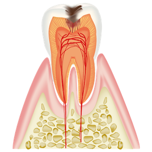 3〜4mm程度の虫歯(c2)