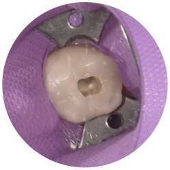 ラバーダム防湿で感染源を断ち切る