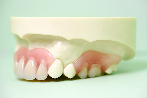 ノンクラスプデンチャー